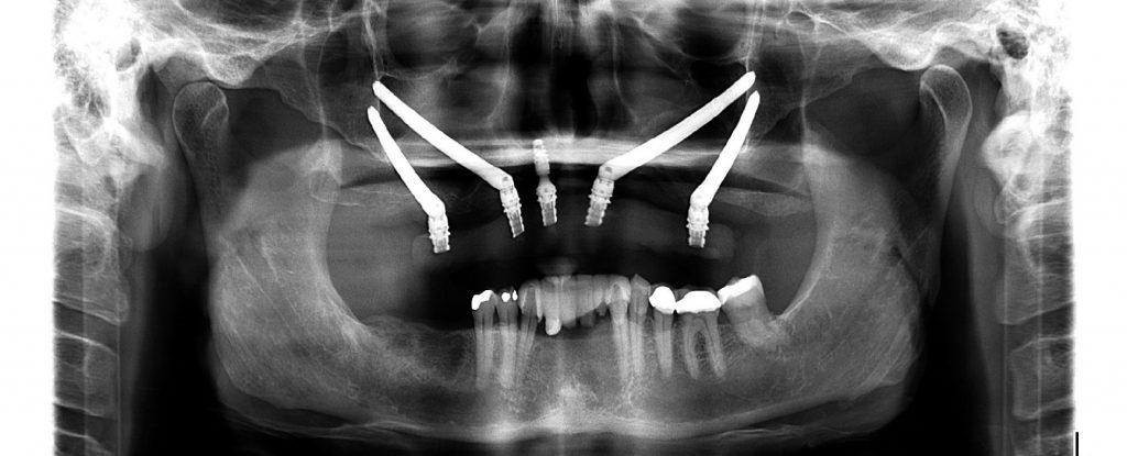 X-ray of Zygomatic implants